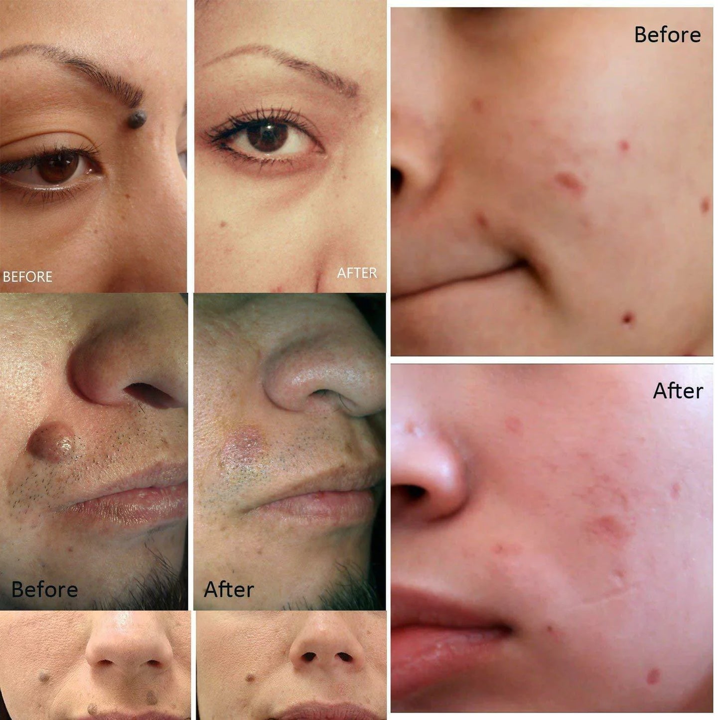 Laser Plasma Pen – Mole & Dark Spot Remover